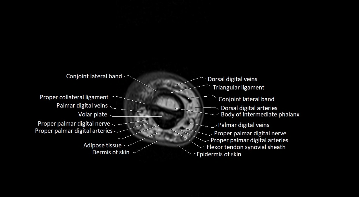 Finger anatomy axial cross sectional 3T image image 10.webp